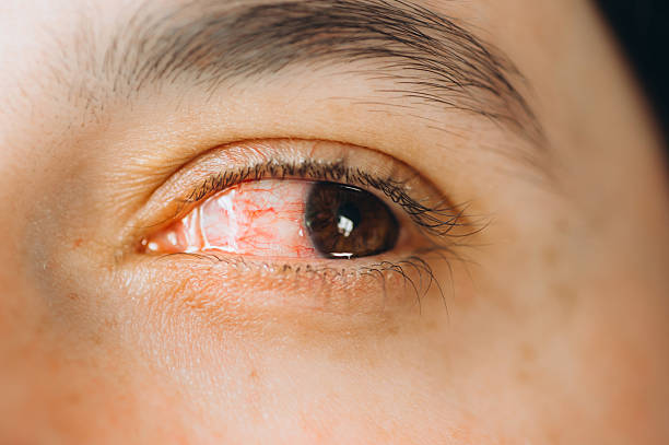 Eye Disease Treatment Aizawl