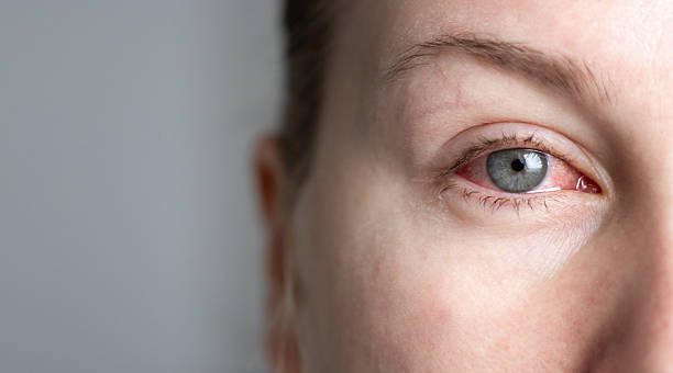 istockphoto-2220085071-612×612 Eye Pain Treatment Aizawl